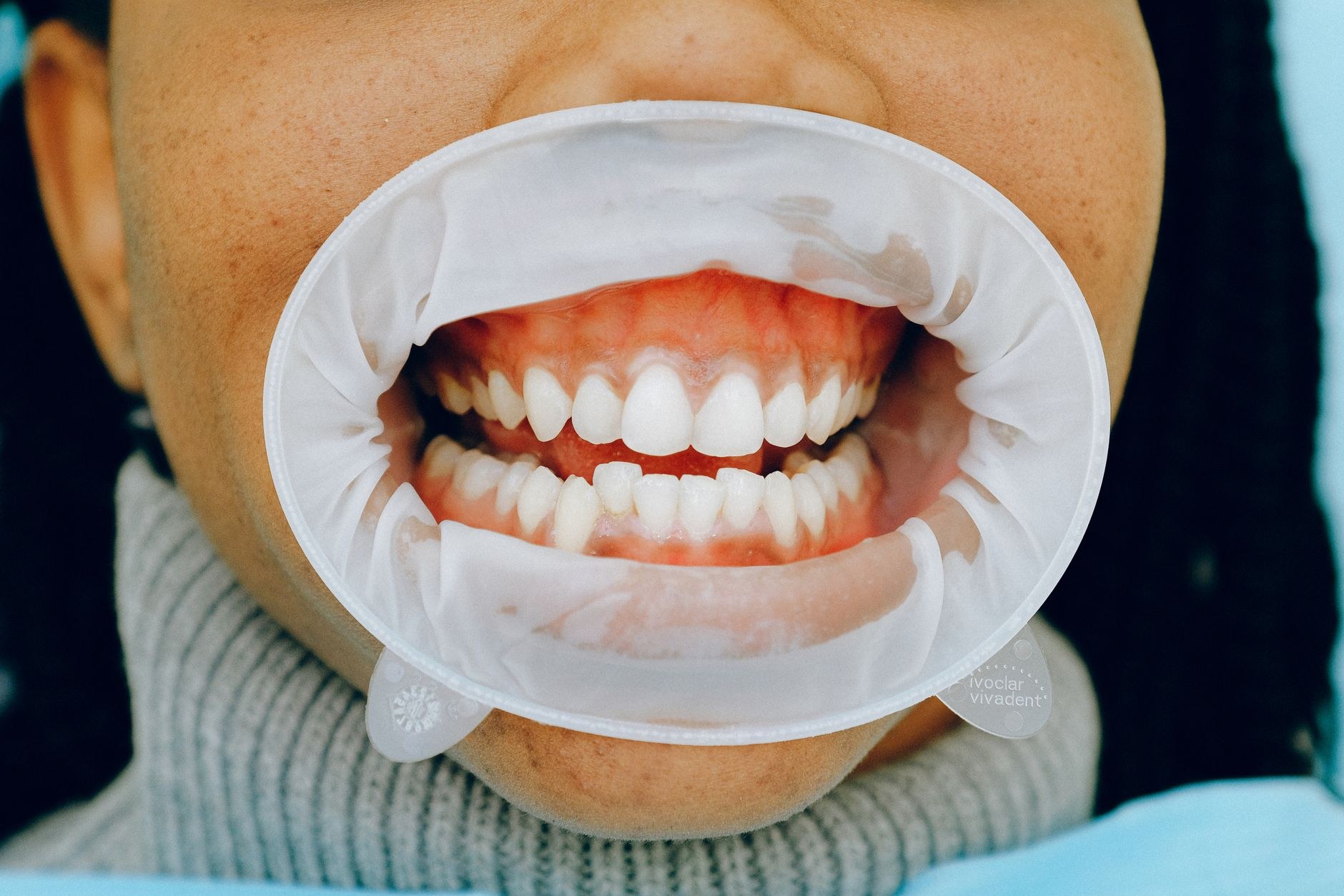 Bright whitened teeth held with a dental retractor